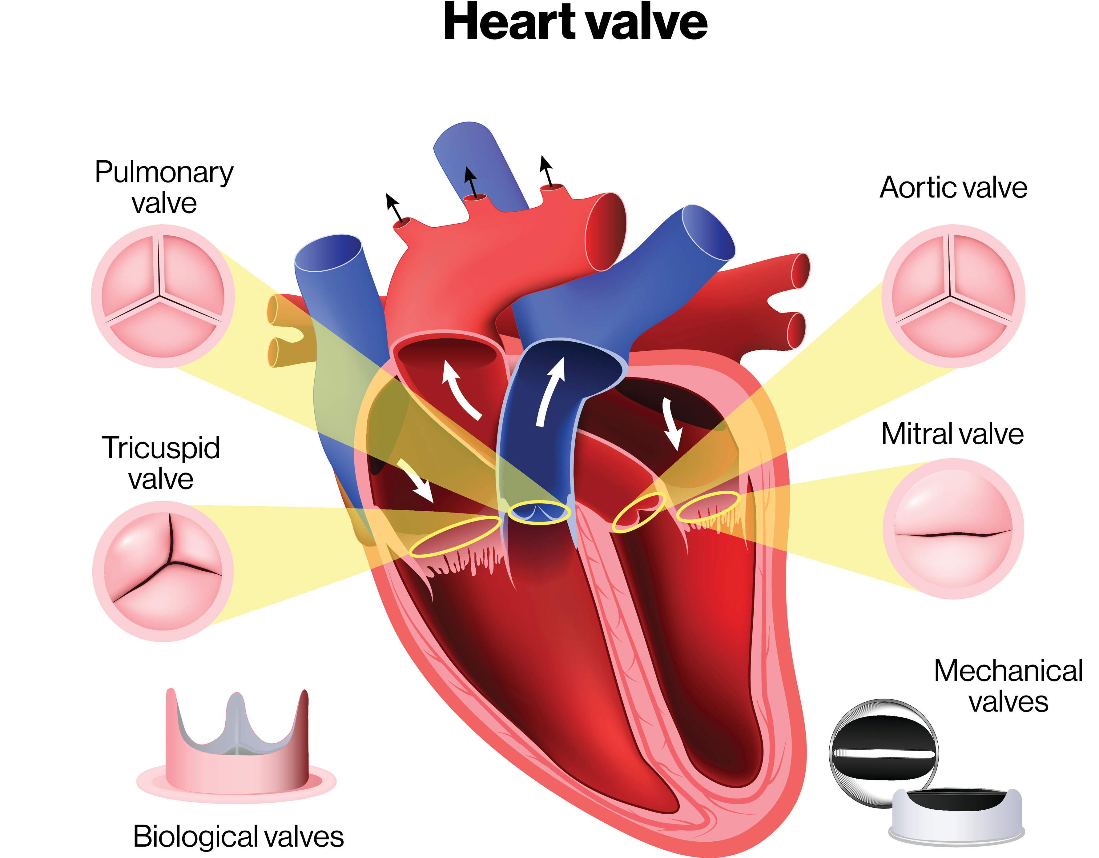 Combined Multi-Valvular Disease